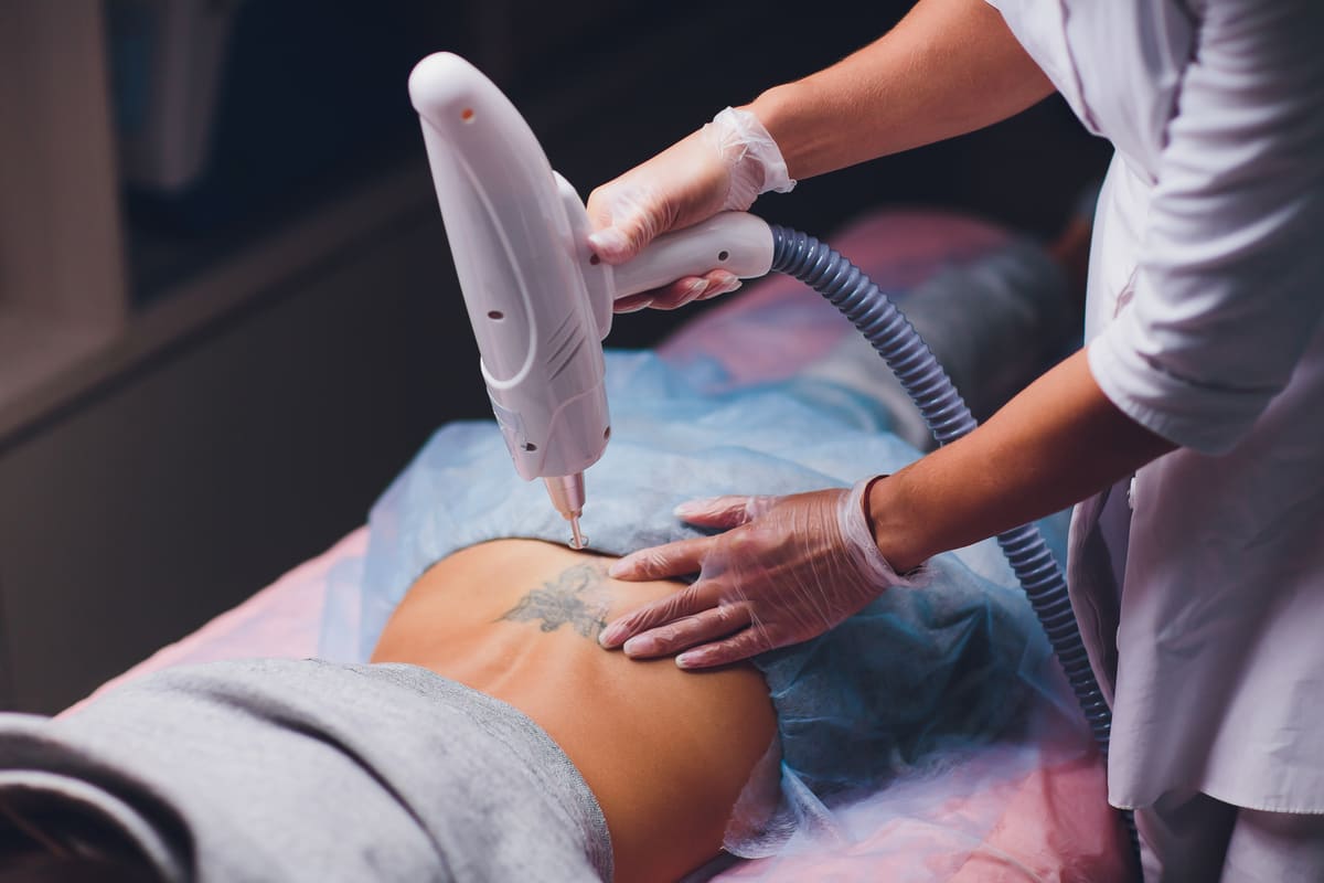 Séance de détatouage réalisée avec un appareil professionnel