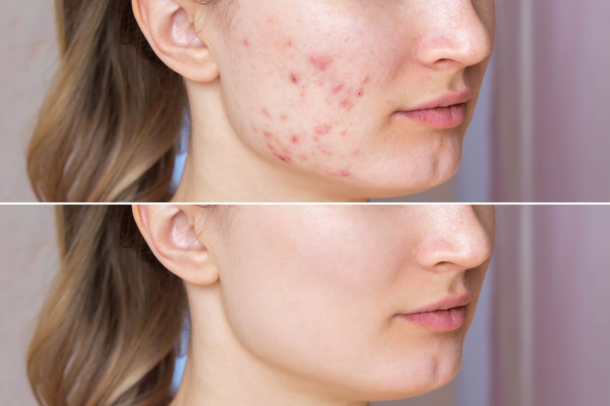 Before/after microneedling on acne-prone skin