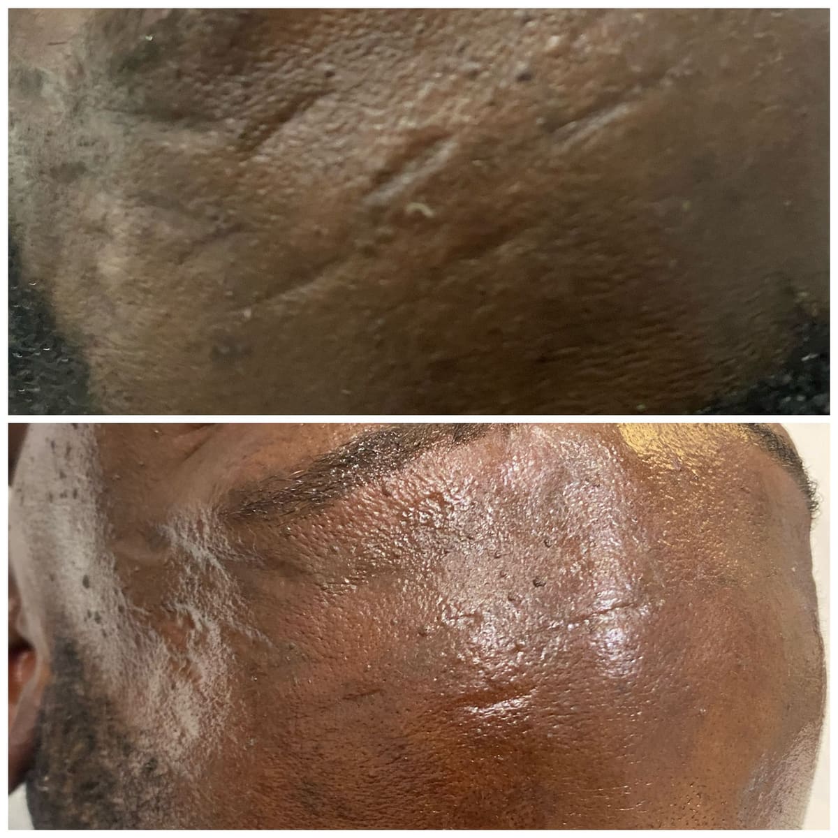 Avant/après de cicatrices du visage traitées par 4 séances de microneedling
